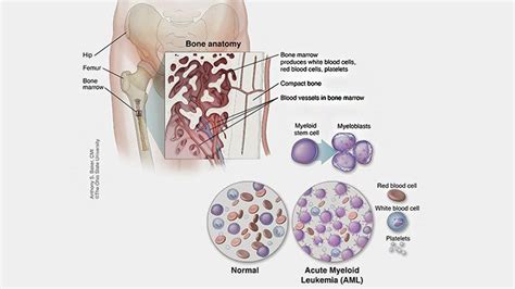 Case study No. 5: Blood Cancer (Acute Myeloid Leukemia) developed as a ...