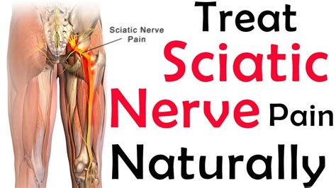 Sciatica Pain Relief — Natural Way to Relieve Sciatic Nerve Pain (without drugs)