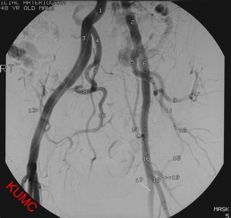 Iliac arteriogram from KU Radiographic Anatomy | Interventional radiology, Radiology, Radiography