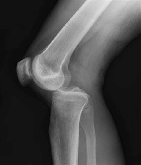 Dislocated Knee – Causes, Symptoms, and Treatment