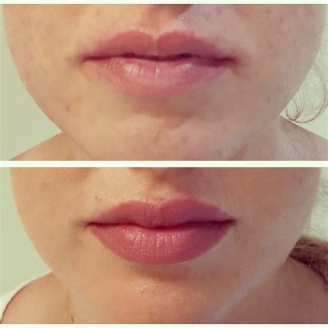 👉 Aumento de labios con ácido hialurónico . Beneficio Puerto Banus, Restylane, Instagram, Lip ...