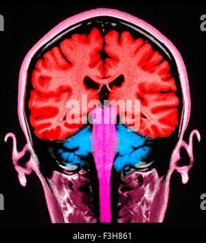 MRI brain scan sagittal plane for detect Brain diseases sush as stroke disease, Brain tumors and ...