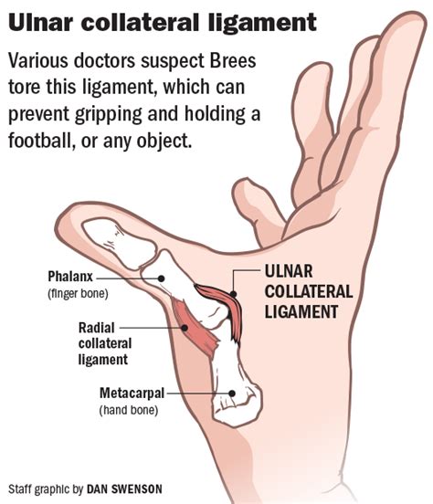 Understanding Drew Brees' thumb injury: What's the UCL? How does the surgery work? | Saints ...