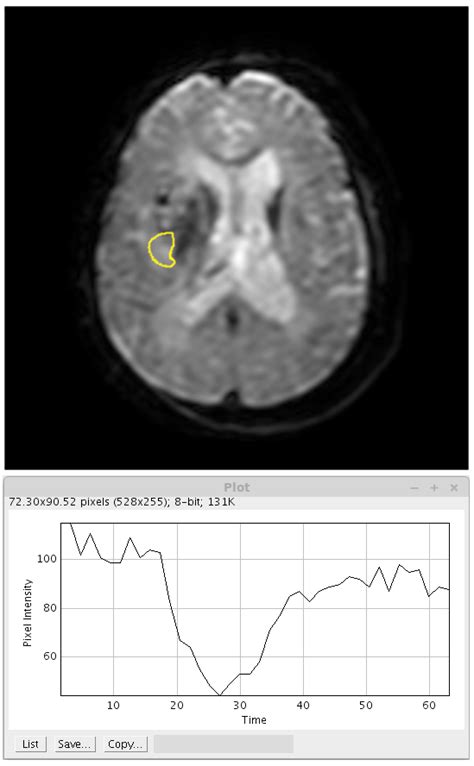 MRI Perfusion - ImageJ