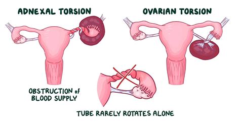 Adnexal torsion: Clinical sciences - Osmosis Video Library