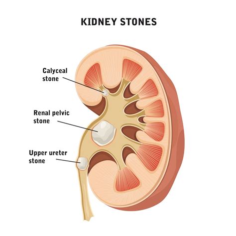 Renal Calculi (Kidney Stones) NCLEX Review