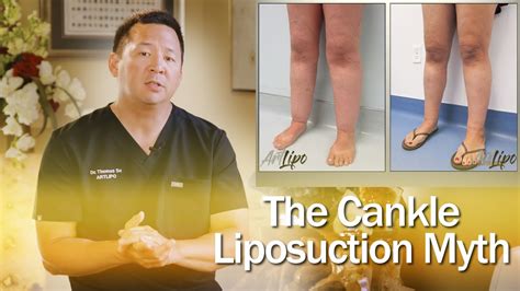 Lipedema Surgery | Cankle Liposuction | Expert Dr. Thomas Su | ArtLipo - YouTube