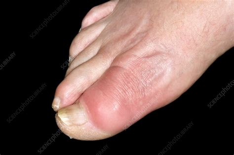 Gout of the big toe - Stock Image - C037/0906 - Science Photo Library