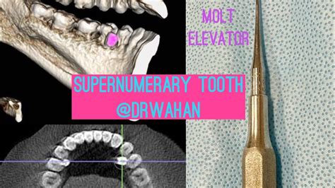 Lingually Positioned Supernumerary Tooth Extraction using Molt Elevator and Periotomes @drwahan ...