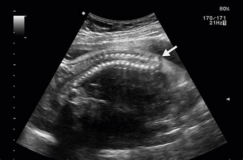 Cureus | Fetal Magnetic Resonance Imaging in Association With Antenatal Ultrasound in the ...