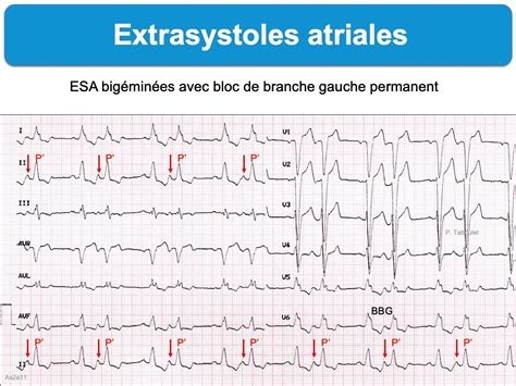 Extrasystole Ecg