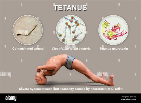 Mechanism of tetanus disease, illustration. A skin wound is ...