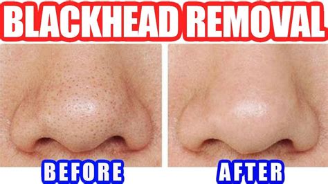 Instrument To Remove Blackheads at Fred Stewart blog