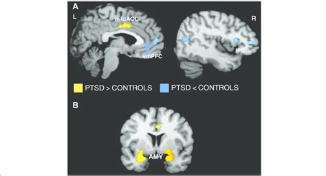 A. Brain regions associated with PTSD across symptom provocation and... | Download Scientific ...