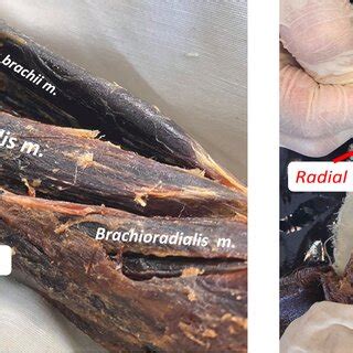 The radial nerve did not innervate the brachialis muscle. | Download Scientific Diagram