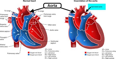 Coarctation of Aorta - In Infants - Symptoms, Murmur, Surgery