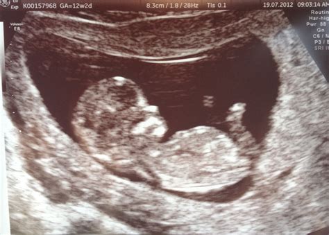 Semi-urban Mom: Diary of a Real Pregnancy - Week 12: The Proof in the Ultrasound Pudding