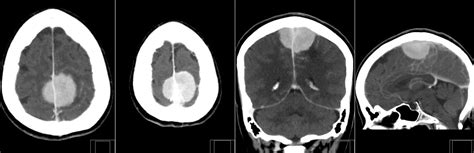 Radiology MRI: Falx Meningioma