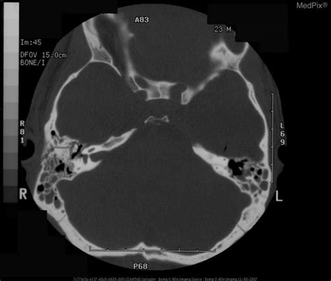 Halo Sign Basilar Skull Fractures and Craniofacial Skull Fractures