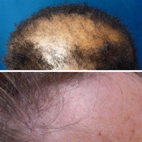 Scarring alopecia encompasses various different forms of alopecia that lead to scarring ...