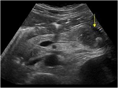 Abdomen and retroperitoneum | 1.3 Pancreas : Case 1.3.6 Pancreatic pseudocysts | Ultrasound Cases