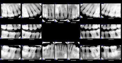 Dental X-rays: Why, Which, & When? - Digital X-rays - Charlotte dentist