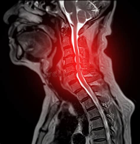 Mri Cervical Spine Disc Herniation Stock Photos - Free & Royalty-Free ...