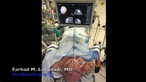 Brain Tumor Surgery: A man with large frontal brain tumor (meningioma) and video of the ...