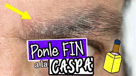 Eliminar la Caspa en las Cejas (ADIÓS a la Dermatitis Seborreica) - YouTube