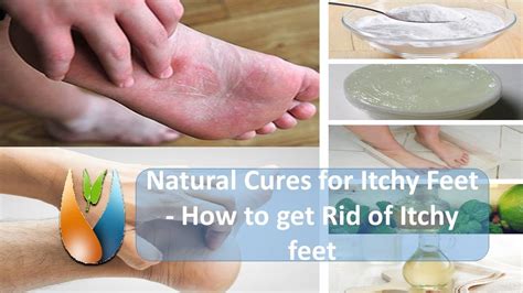 Natural Cures for Itchy Feet -How to get Rid of Itchy feet ? - YouTube