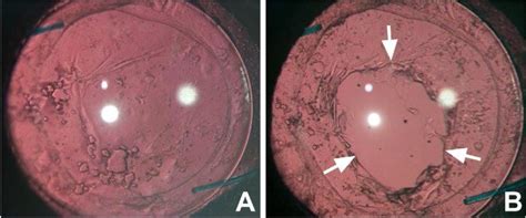 Posterior Capsular Opacification (PCO) | myeyespecialist