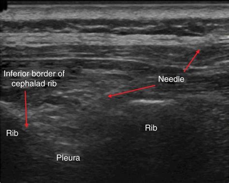 Intercostal Nerve Block | Anesthesia Key