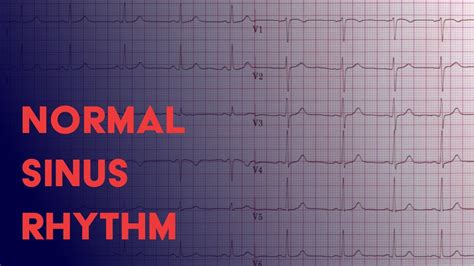 What Is A Normal Ekg Look Like