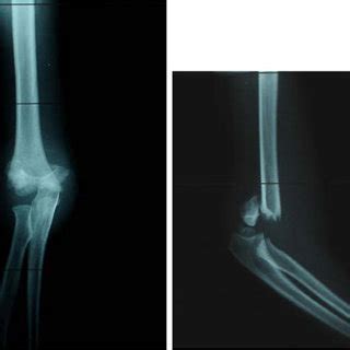 A 4-year-old girl with Gartland type III fracture | Download Scientific Diagram