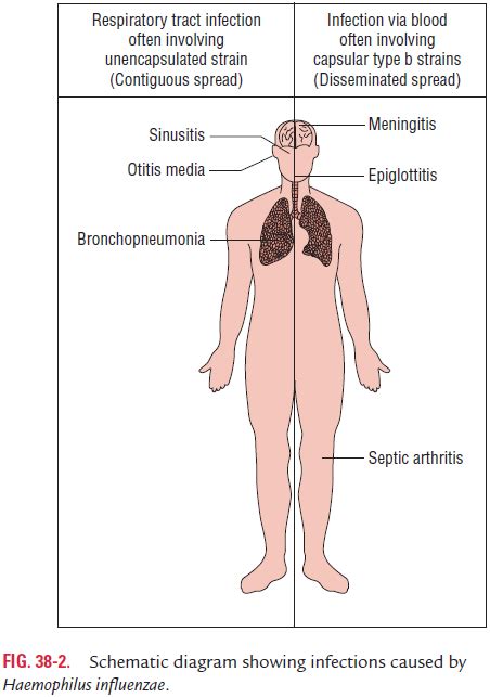 Clinical Syndromes - Haemophilus influenza