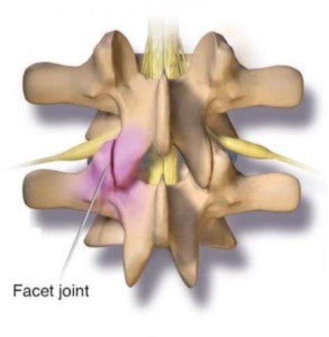 Synovial Cyst Diagnosis & Treatment - NYC | Columbia Neurosurgery in ...