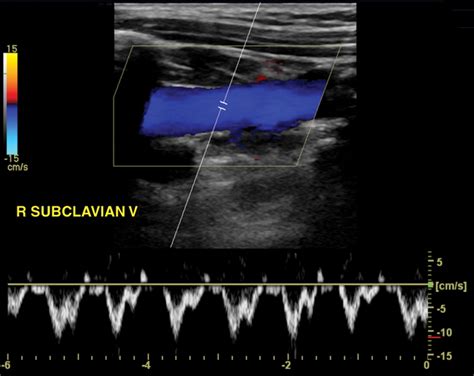 Venous Waveform Ultrasound | My XXX Hot Girl