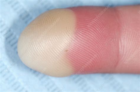 Paronychia infection of the finger - Stock Image - C016/8167 - Science Photo Library