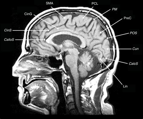 Figure 2, [Figure 2 Midline sagittal T1-weighted...]. - Glioblastoma - NCBI Bookshelf