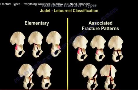 Acetabulum fracture Classification — OrthopaedicPrinciples.com