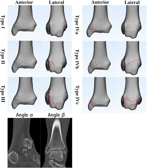 Medial Malleolus Fracture Discount Shop | www.deborahsilvermusic.com