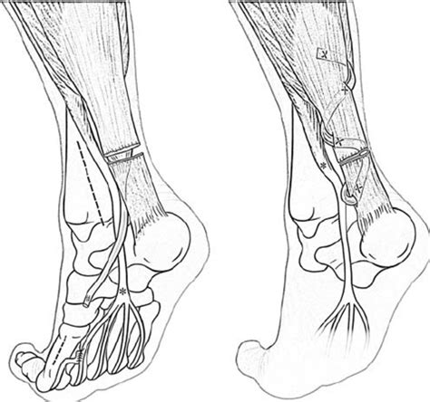 Distal dissection of the flexor hallucis longus tendon (#) (left). ⇒ ...