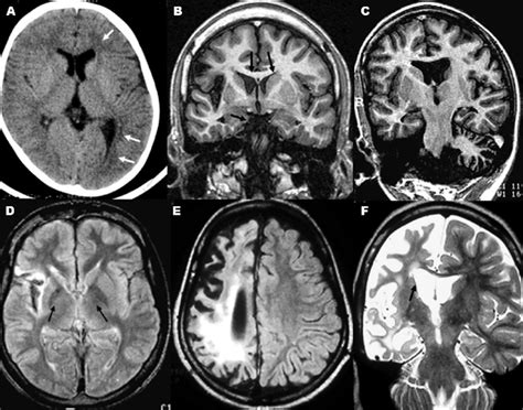 [A] CT. Left hemispheric atrophy with ventricular and cortical sulci... | Download Scientific ...