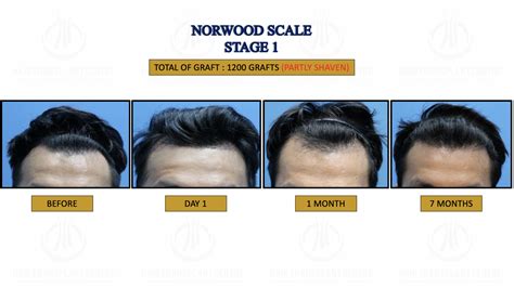 FUE Hair Transplant Li Ads - Hair Transplant Centre Malaysia