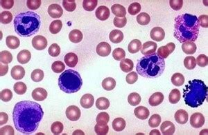 High Monocytes Count - Description, Causes, Treatment