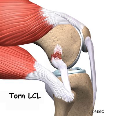 COLLATERAL LIGAMENT TEAR : PATIENT'S GUIDE