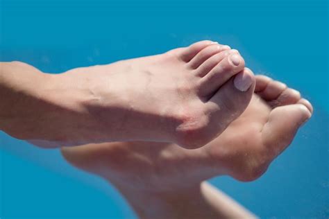 Bunions, Hammertoes & Crooked Toes Are Serious and Often Need ...