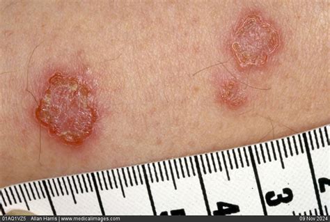 STOCK IMAGE, dermatology infected eczema red round and crusty patcheson ...