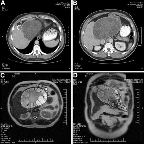 An Ill-Defined Upper Abdominal Mass - Clinical Gastroenterology and ...