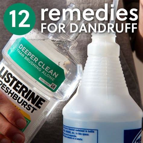 Dandruff treatment, Remedies and Dandruff remedy on Pinterest